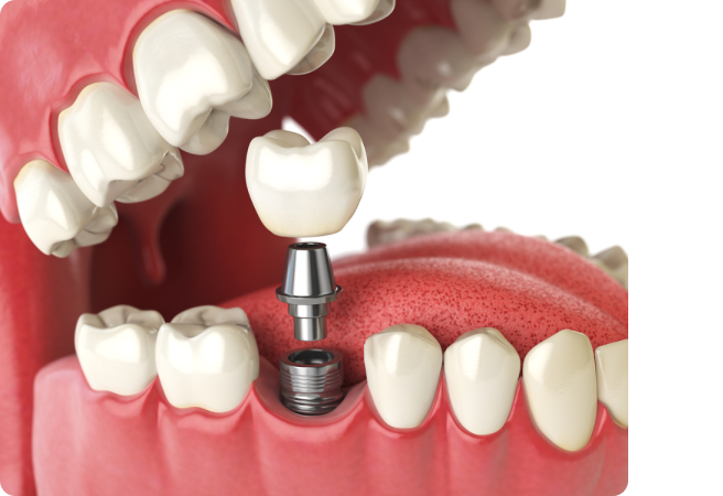 Dental Implants Wellington NZ