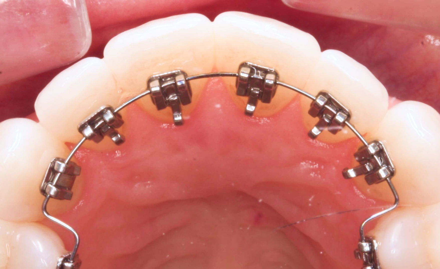Inside mouth view of dental work