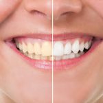 How To Whiten Your Teeth For A Brighter Smile