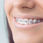 What Are The Differences Between Invisalign® And Braces?
