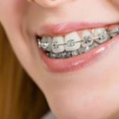 Six Things You May Not Know About Braces