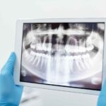 What are Dental Implants and How Do They Work?