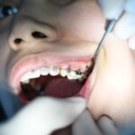 Braces 101: What to Expect When Getting Braces