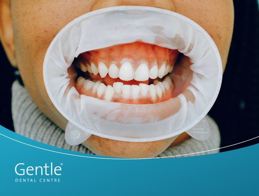 Receding gums: Prevention and treatment of receding gums